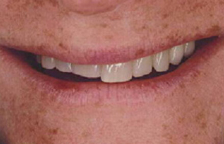 Woman with worn down teeth due to bruxism