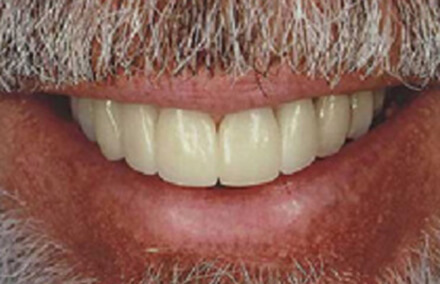 Man with flawless smile repaired with Empress porcelain veneer crowns