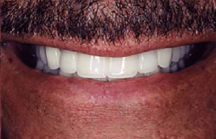 Man with flawlessly repaired smile with Empress crowns, veneer crowns, and porcelain to gold bridge