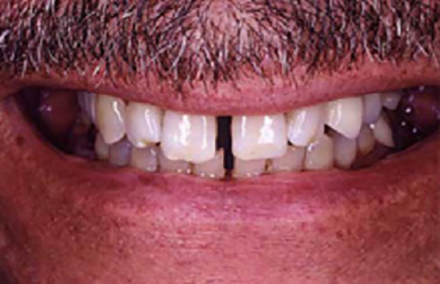 Man with large gap between front teeth