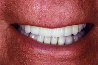 Man's smile with teeth fitted together well with empress veneers and porcelain to gold crowns and bridges