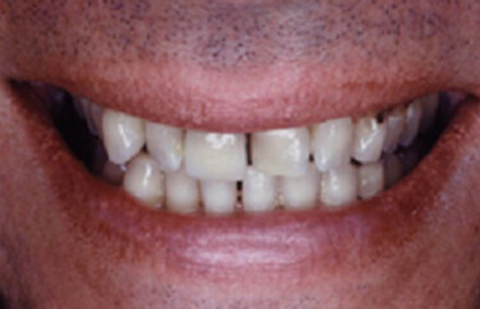 Man's smile with misshapen unevenly spaced teeth