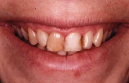 Yellow front tooth and other smile stains