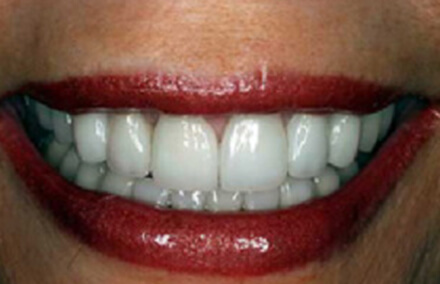 Corrected front teeth and beautiful smile after treatment with empress veneers and porcelain to gold crowns