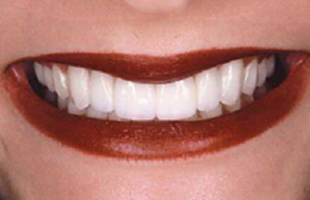 Evenly spaced white smile repaired with veneers and crowns