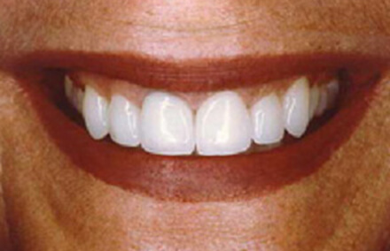 Zirconia crown and bridge and Empress veneers concealing dental stains