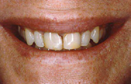 Severe staining on front two teeth