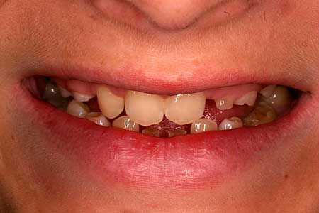 Smile with missing and damaged teeth