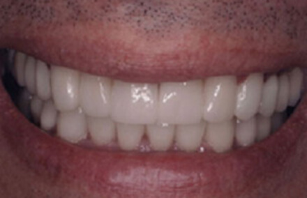 Flawless looking zirconia crown repaired teeth