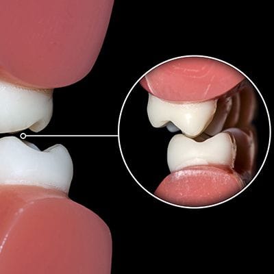 Closeup of bite in need of occlusal adjustments