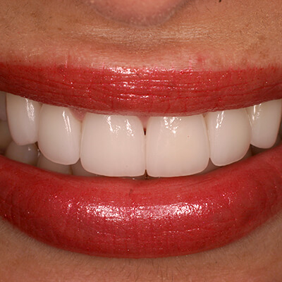 Closeup of smile with porcelain veneers