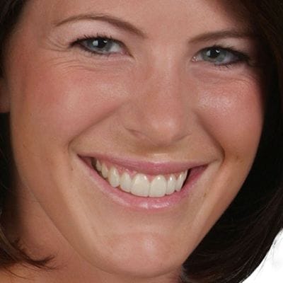 Patient smiling after veneer placement