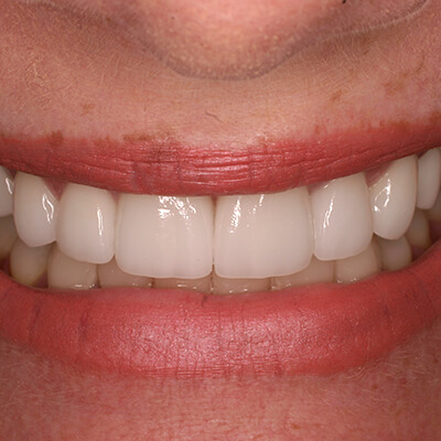 Closeup of perfect smile after porcelain veneers