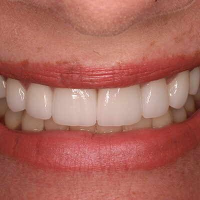 Close up of perfect smile after veneers