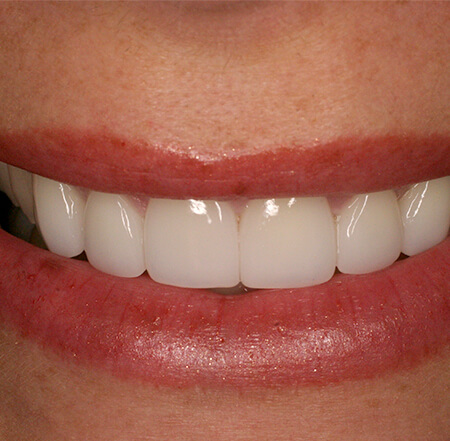 Smile after porcelain veneers