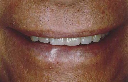 Man's smile after porcelain veneer enhancement