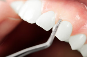 Dental instrument cleaning teeth