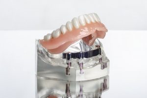 model of dental implants