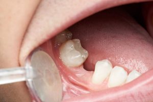 person missing a back tooth