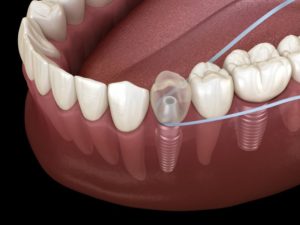 demonstration of flossing dental implants