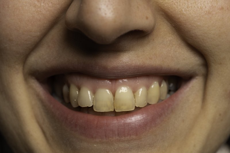 closeup of mouth with stained teeth in San Marcos