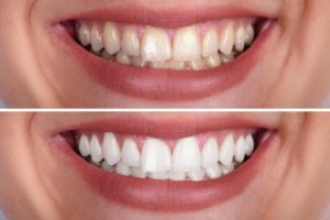 a before/after comparison of two smiles