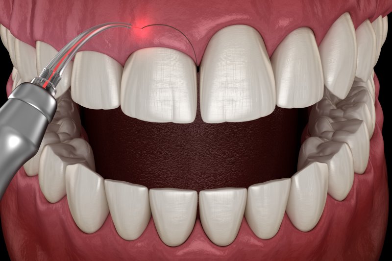 a 3-D diagram of gum recontouring