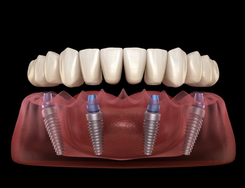 digital image of dental implants