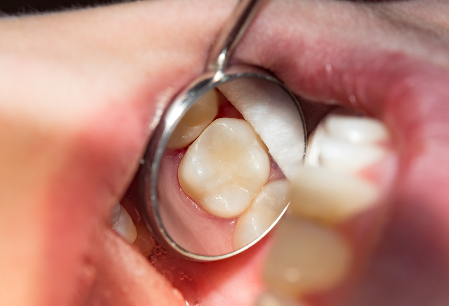 Close up of dental filling in dental mirror