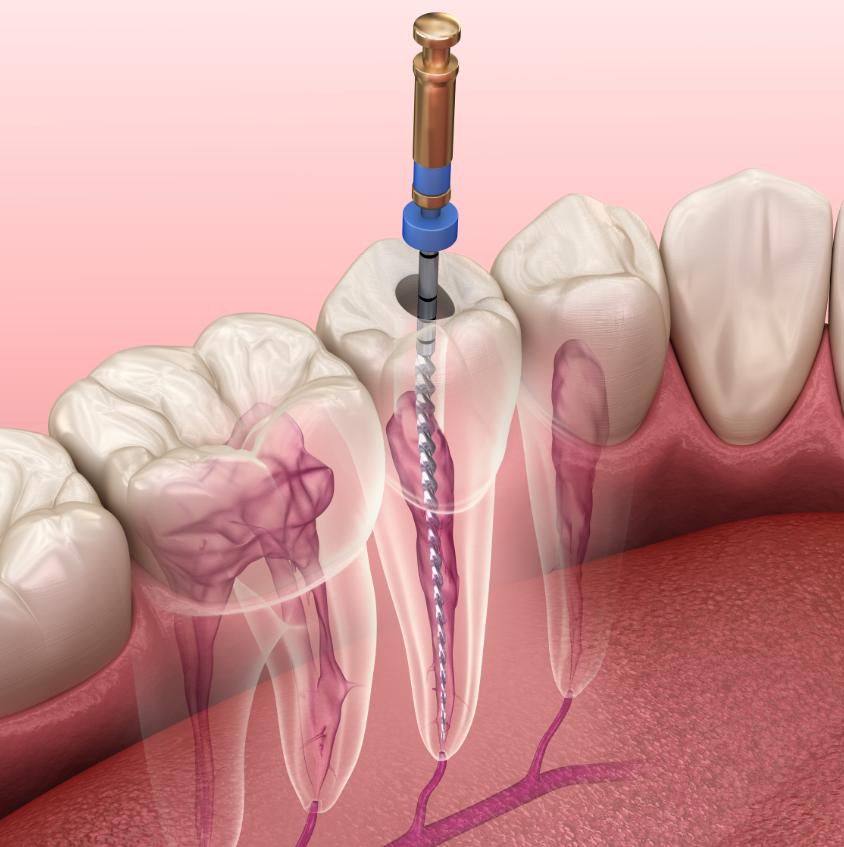 Illustrated root canal cross section