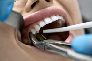 Dentist performing tooth extraction.